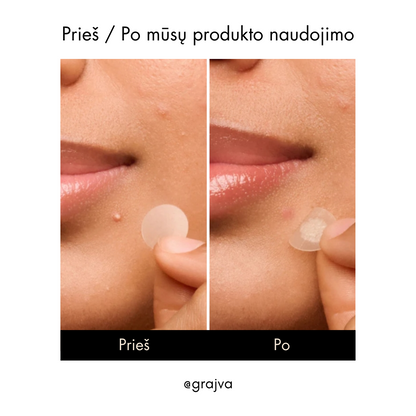 Grajva - Spuogų Pleistras