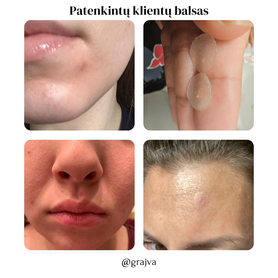 Grajva - Spuogų Pleistras